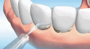 洗牙是怎么回事？