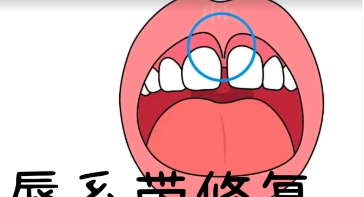 舌系带 / 唇系带松解术