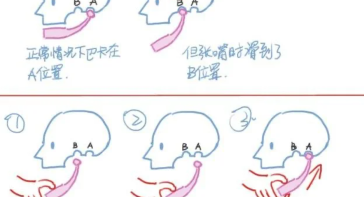 颞下颌关节复位