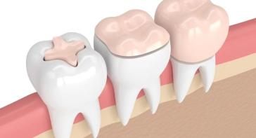 全瓷冠（氧化锆 / 玻璃陶瓷 / 铸瓷）