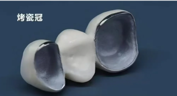 金属烤瓷冠