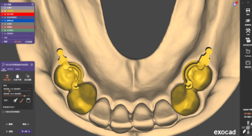 精密附着体义齿