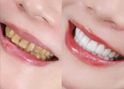 四环素牙/氟斑牙美白