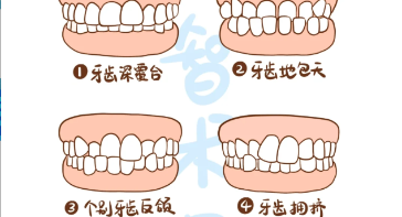 牙列拥挤 / 反颌 / 深覆合 / 开颌矫治