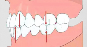 咬合重建类正畸
