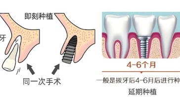 单颗拔牙后延期种植