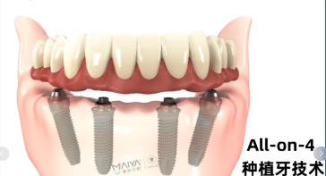 半口或全口即拔即种