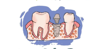 半/全口拔牙后延期种植