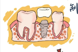 半/全口即拔即种 + 即刻负重