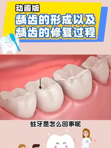 龋齿是如何形成的？医生怎么处理龋齿的？#龋齿补牙